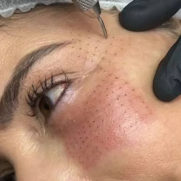 Lifting Parpados Facial