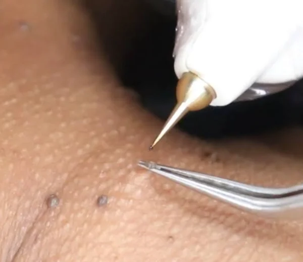 Plasmapen Eliminación Verrugas